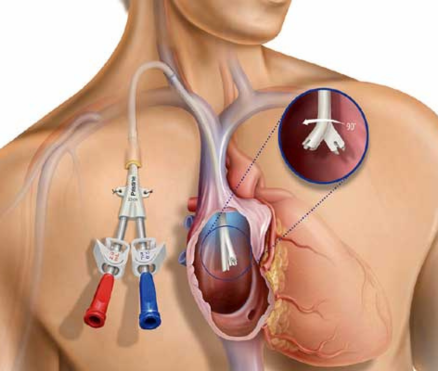 Dialysis Catheter Placement- Internal Jugular Catheter, Femoral Catheter and Permacath Placement.